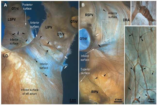 (B) pulmonary veins Vaitkevicius R