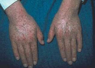 Mutációs betegség: xeroderma pigmentosum.