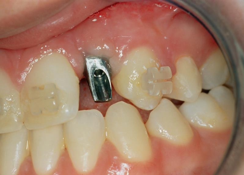 EGY FOG HIÁNYA IMPLANTÁCIÓS PROTETIKAI ELLÁTÁS AZONNALI IMPLANTÁCIÓ ÁLTALÁBAN A