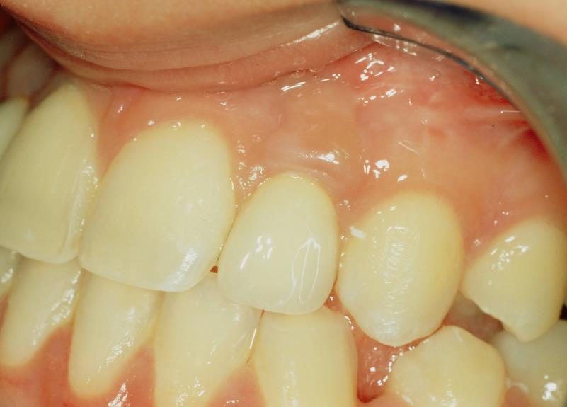 ALVEOLUS-IMPLANTÁTUM MÉRETE ÉS A PARODONCIUM ÁLLAPOTA FÜGGVÉNYÉBEN KÉSŐI