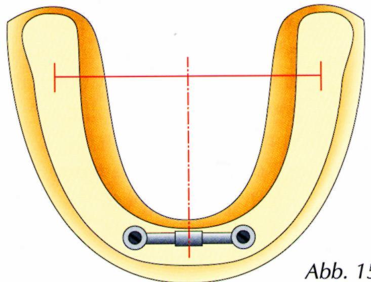 FOGATLAN ÁLLCSONT IMPLANTÁTUMMAL ELHROGONYZOTT, IMPLANTÁTUMON ÉS NYÁLKAHÁRTYÁN