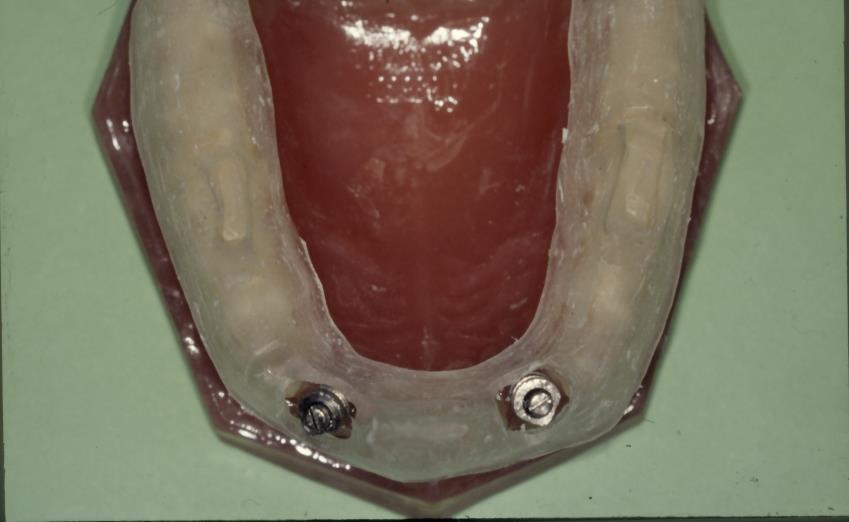 AZ IMPLANTÁCIÓS FOGPÓTLÁSOK