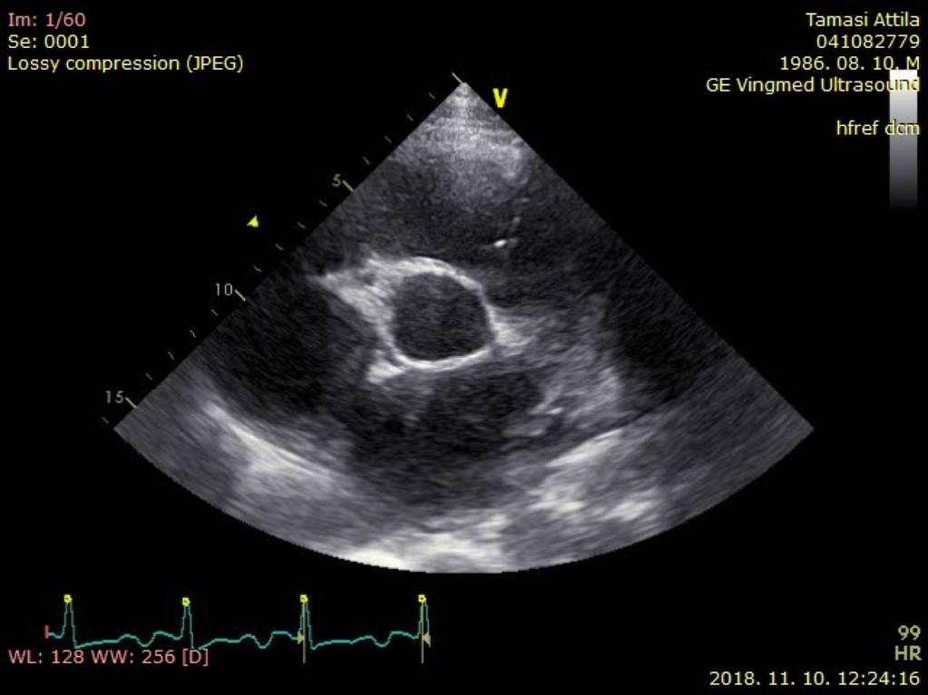 Qp/Qs Qp Jobb kamrai stroke volumen: RVOT D: Mérése: PSAX, módosított