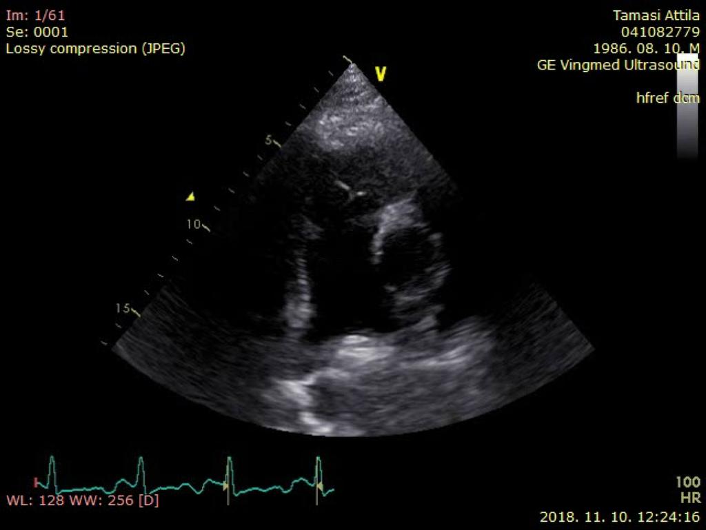 Qp/Qs Qp Jobb kamrai stroke volumen: RVOT D: Mérése: PSAX, módosított PLAX Inner edge-to-inner edge End szisztoléban,