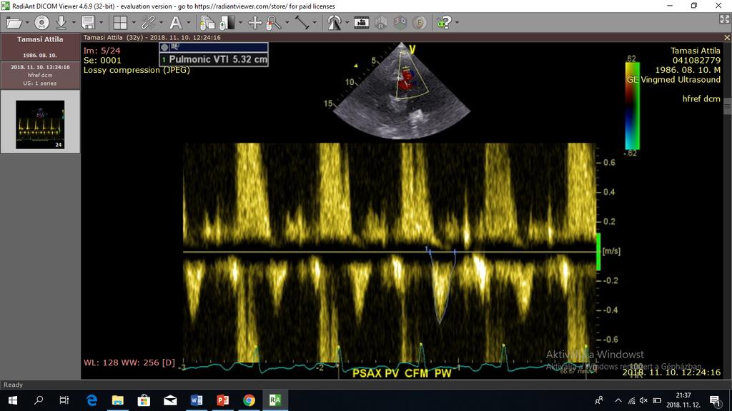 Qp/Qs Qp Jobb kamrai stroke volumen: RVOT VTI: PSAX PW Doppler A billentyű síkja alatt (0,5-1 cm, CD és PR szerepe) PW kapu: 3-5 mm Optimális beállítások: baseline, speed, gain Éles, körülhatárolt