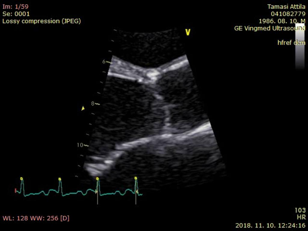 Qp/Qs Qs: Bal kamrai stroke volumen LVOT D: Mérése: