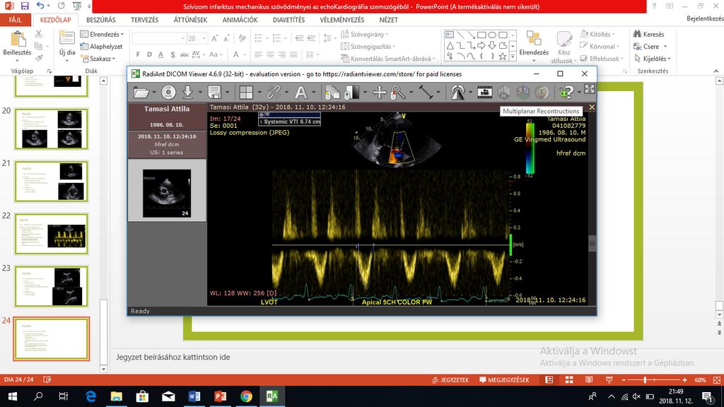 Qp/Qs Qp Jobb kamrai stroke volumen: RVOT VTI: PSAX PW Doppler A billentyű síkja alatt (0,5-1 cm, CD és PR szerepe) PW kapu: 3-5 mm Optimális beállítások: baseline, speed, gain Éles, körülhatárolt