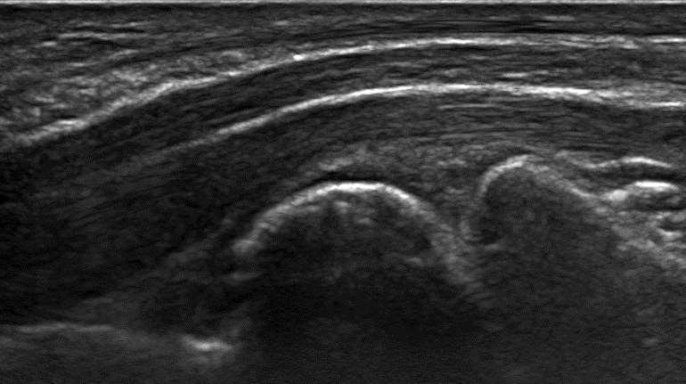Carpalis alagút syndroma: ideg