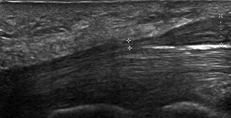 Carpalis