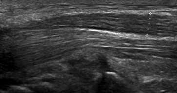 Carpalis