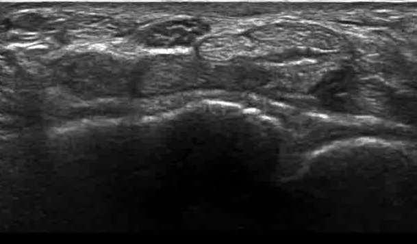 proximal felől