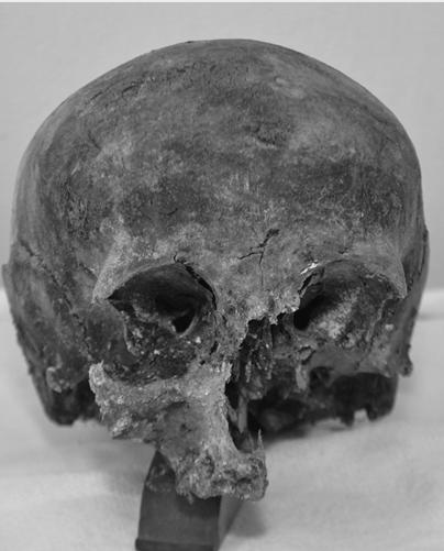 figyelhetők meg. Az endocranialis obliteratio 5. fokozatú. A maxilla fogmedri részén az alveolusok begyulladtak. Az orrüregi régió egy része is hiányzik. A maxillában nincsenek fogak.