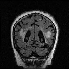Diagnosztika : MRI- és egyéb neuroradiológiai vizsgálatok Az artériás Ocularis stroke - indirekt intrakraniális MR jelek az ún.