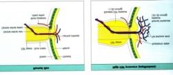 OS : Papilla oedema +/- Diplopia (centrális szemmozgás zavar) KNyF:Koponyaűri NyomásFokozódás vagy IIH : Idiopátiás Intrakraniális Hypertenzió (liquor felszívódási zavar - intracerebrális vénás