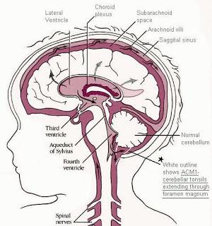 OS : Papilla oedema +/- Diplopia hátterében :