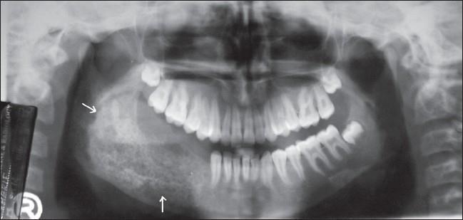 RADICULARIS CISZTÁK ELÜLÖNÍTŐ DIAGNOSZIKÁJA Fibrosus dysplasia Patogenezis ismeretlen