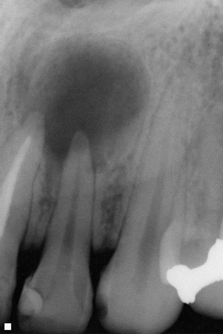 CISZTARADICULARIS Gyulladásos eredet Pulpanecrosis elhalt fog gyökércsúcsán jelenik meg