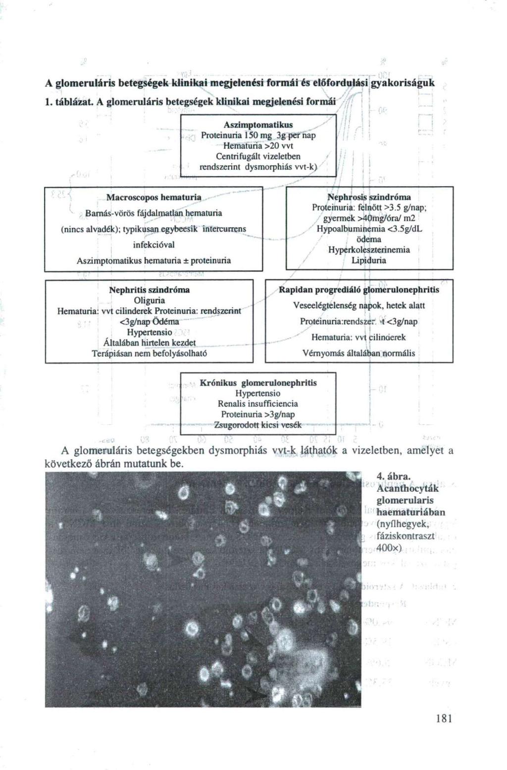 VQ-í A glomeruláris betegségek klinikai megjelenési formái és előfordulási gyakoriságuk 1. táblázat. A glomeruláris betegségek klinikai megjelenési formái /1!