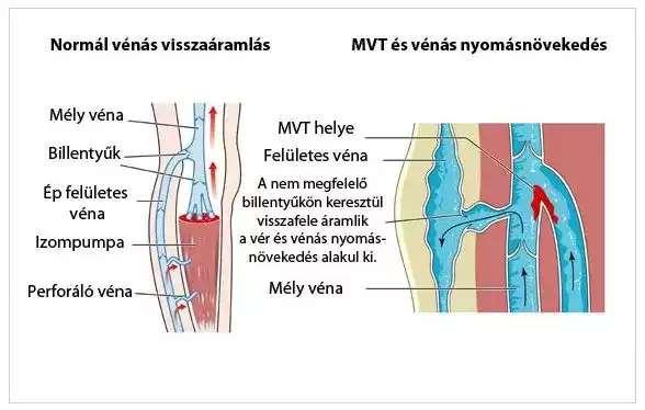 Mélyvénás trombózis Mélyvénás trombózis alakul ki, ha valamelyik mély vénában vérrög alakul ki.