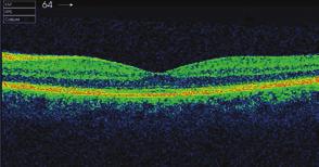 A szemészeti vizsgálatok jelentősége a cukorbeteg-gondozásban Összefoglaló közlemény 2. ábra. Nonproliferatív diabeteses retinopathia. Vérzések, microaneurysmák láthatók pen pedig pl.