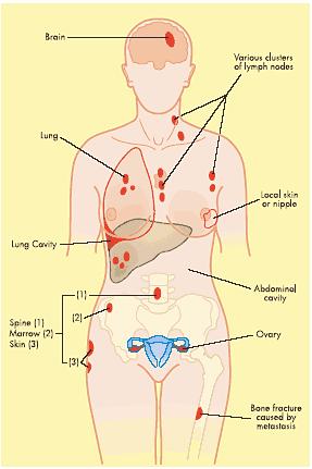 METASZTÁZISOK: csontok, tüdő és pleura, máj, agy de bárhová adhat áttétet Az egyes