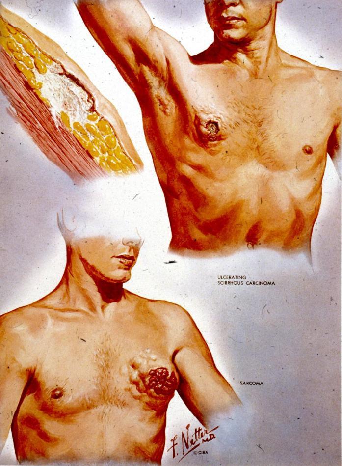 FÉRFI EMLŐ GYNECOMASTIA Pubertás Májcirrhosis Hormontermelő heretumor Tüdőrák: