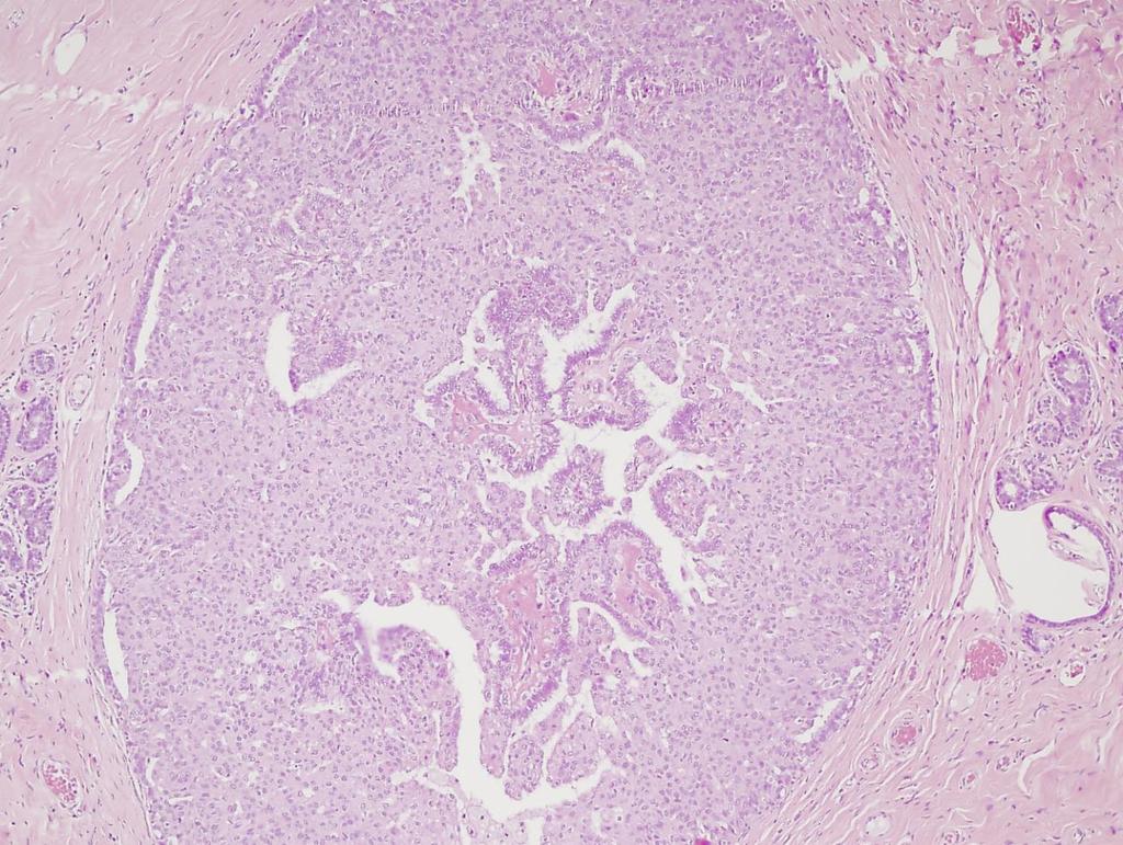 intraductalis papilloma laktáció