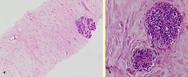 Figure1 Diabetic mastopathy.