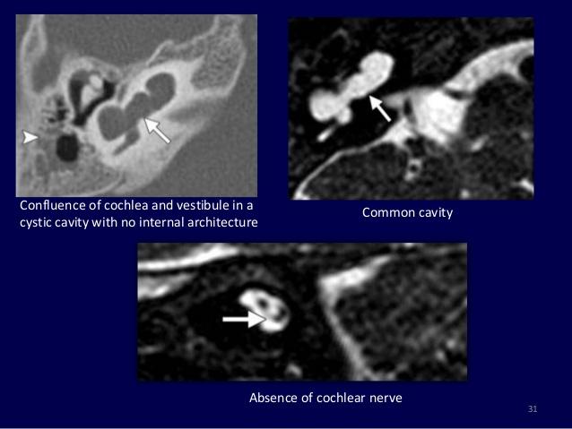fül hiány petrosus hypoplasa atresias iac MR: VIII nem látható cochlearis malformatiok 25%-a Cochlea