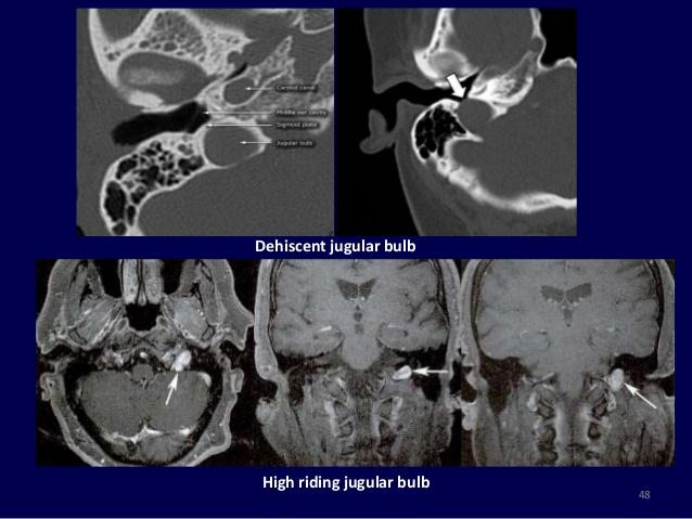 tinnitus, hemifacialis spasmus a cervicalis ACI inkomplett regressioja miatt aberráns ACI éles posterolateralis lefutás a dobüregen keresztül, a promotriumra