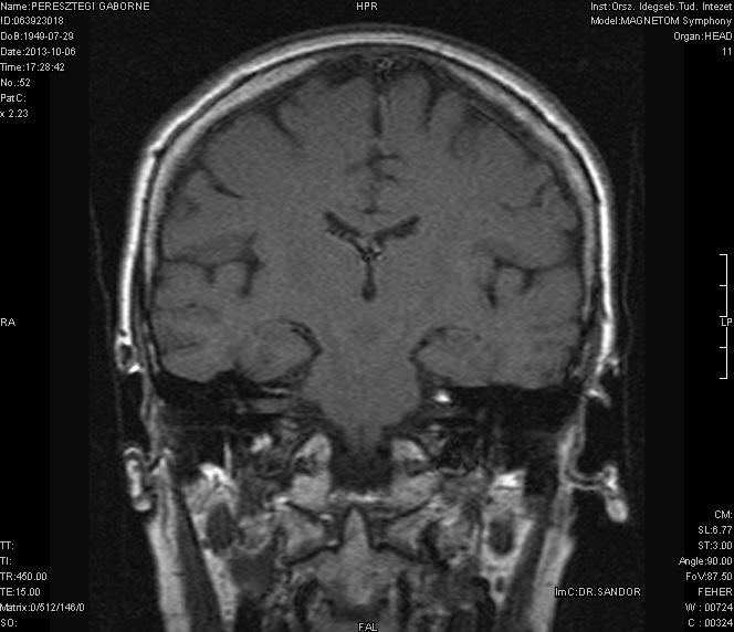 intracanalicularisan és tympanicusan Vestibularis