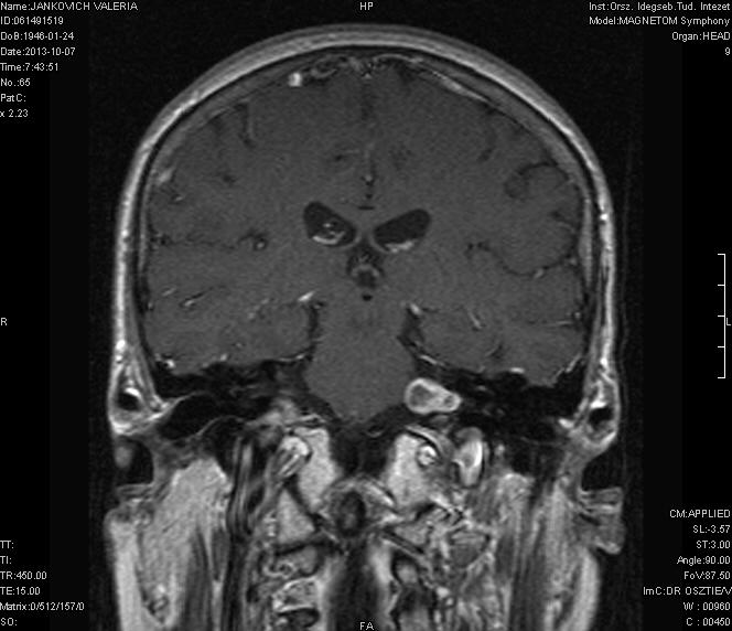 SNHL tinnitus, hemifaciális spazmus, otalgia