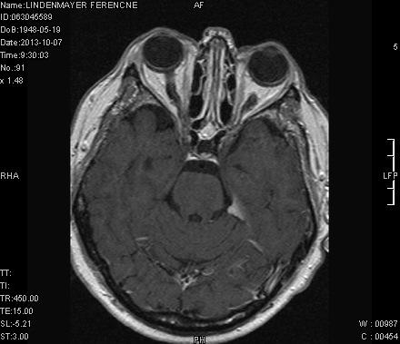 (paraganglioma) hypervascularizált, lokálosan