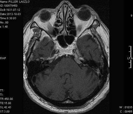 vagale nasopharyngealis cc lymphoma pulsatilis