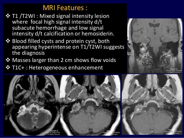 SNHL+tinnitus+vertigo heterogen tumor, bevérzések, calcificatio kirágott retrolabyrinthin pyramis intratumorális spiculált