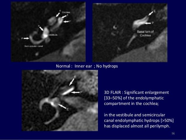 fehérjedús cysta - T1 hyperintenzitás fokozott hydraulicus nyomás a belső fül endolymphaticus rendszerében idiopathiás -