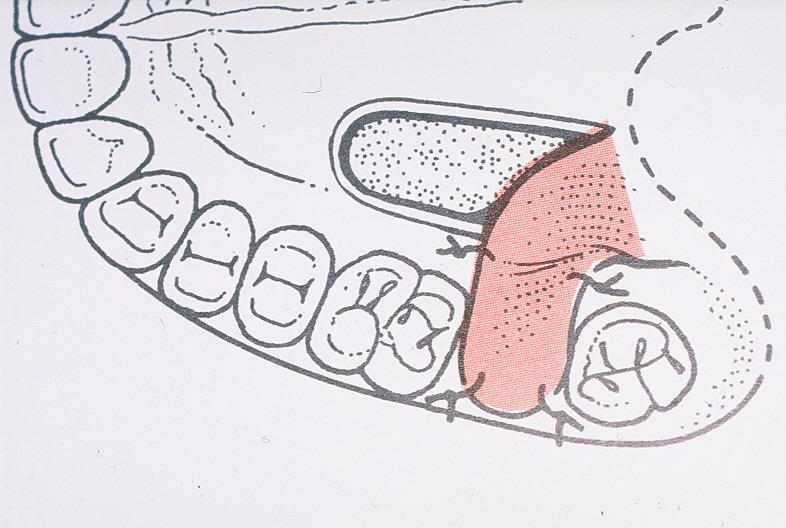 Palatinális lebennyel történő zárás hátrányai szájpadlás