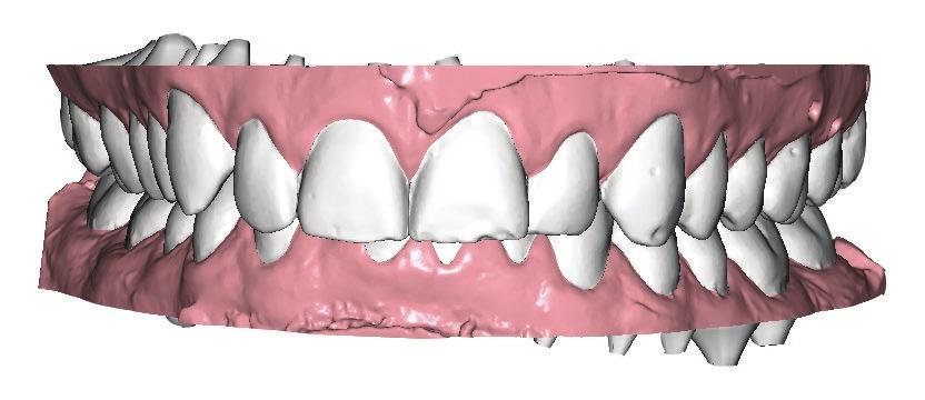 Mélyharapás, ClearSolution Implant mélyharapás A harapási rendellenességek közül a leggyakoribb a lakosság körében a különböző mértékű mélyharapás, ami az európaiak 65-70%-nál fellelhető.
