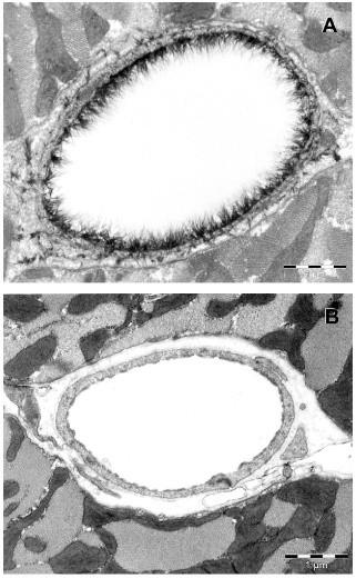 Curr Opin Anaesthesiol 2009; 22: 155-62 Hypervolemia