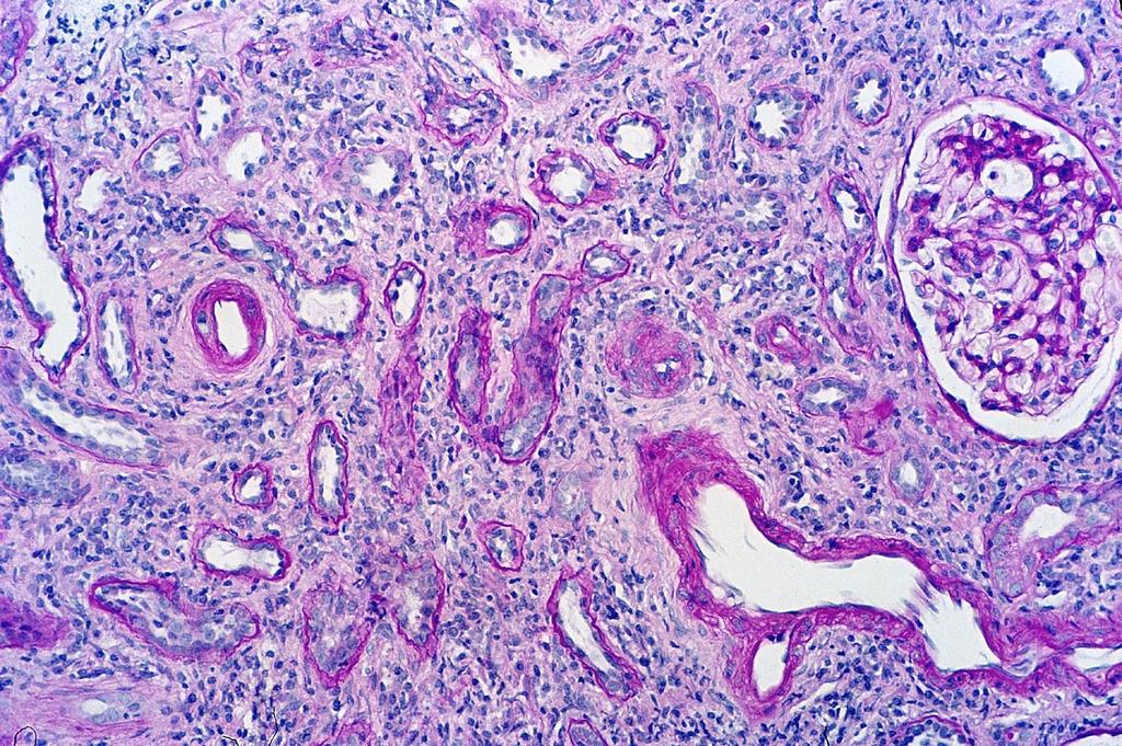 Idült TIN: interstitialis fibrosis, a