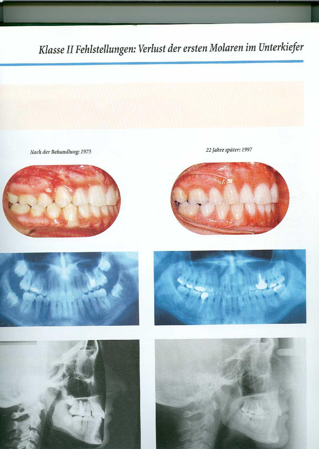 osztályba kell állítani Elsősorban a maxilla anteropozíciója vagy