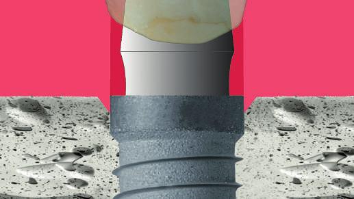 A lágyszövetek stabilitása amelyhez a Curvomax felépítmény profilja nagymértékben hozzájárul az elért esztétikai eredmény fenntartása és az implantátum körüli szövetek egészségessége szempontjából