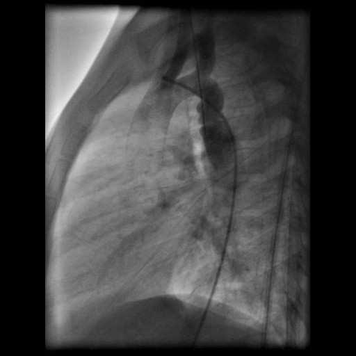 Coarctatio aorta