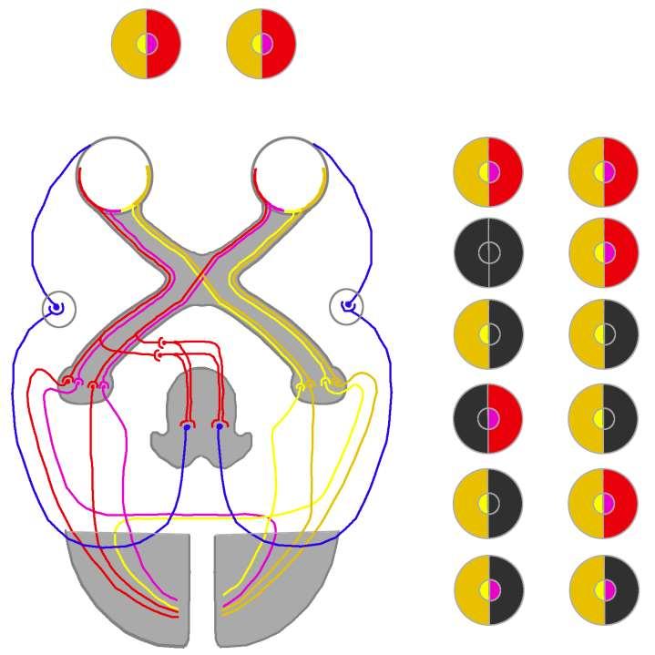 Látótérkiesések neuropathológiája 4 2 1 3 Normális látóterek 1. Bal amaurosis (anopsia) 2.