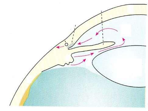 Normális csarnokvíz-elfolyás angulus iridocornealis spongiosa sclerae Schlemm s