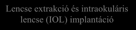 A lencsehomály helyétől függően (corticalis, nuclearis, subcapsularis) előbb vagy