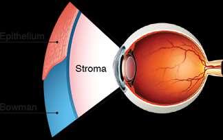 A refrakciós anomáliák korrekciója lupe, szemüveg, kontaktlencse,