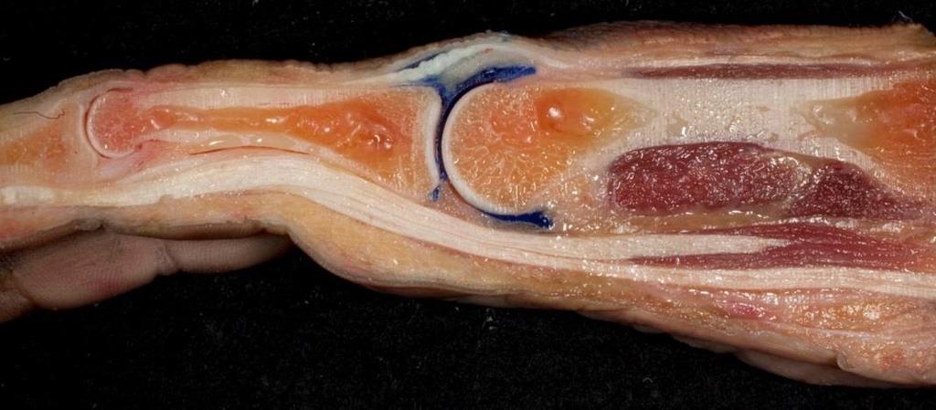 Articulationes metacarpophalangeae (MCP)