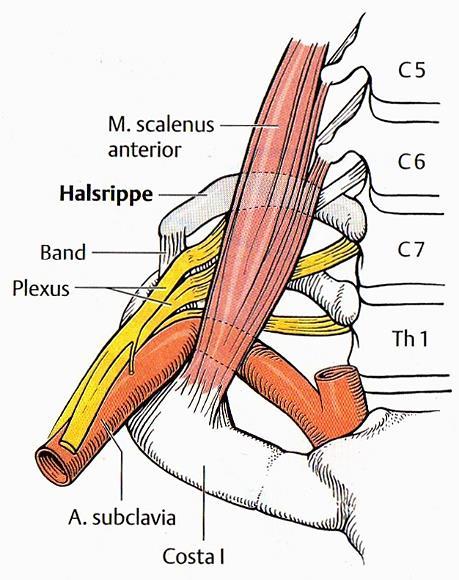 Plexus brachialis Duus