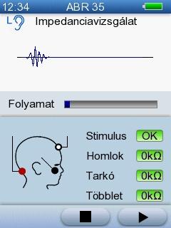 5 Vizsgálat az AccuScreen -el Mindkét fül vizsgálata Ha fülcsatlakozókkal végzi a vizsgálatot, a Binaurális gomb jelenik meg. Nyomja meg ezt a gombot mindkét fül vizsgálatához. 5.4.